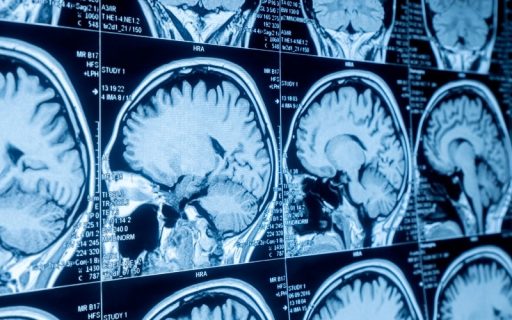 Cancer Neuroscience of Brain Tumors