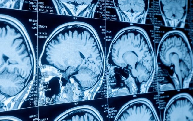 Cancer Neuroscience of Brain Tumors