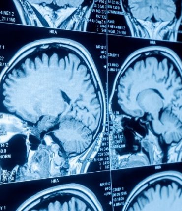 Cancer Neuroscience of Brain Tumors