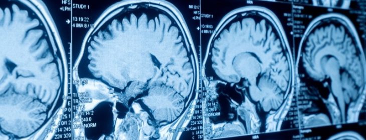 Cancer Neuroscience of Brain Tumors