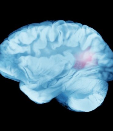 AllergoOncology: Lessons Learned from the Allergy-Glioblastoma Connection