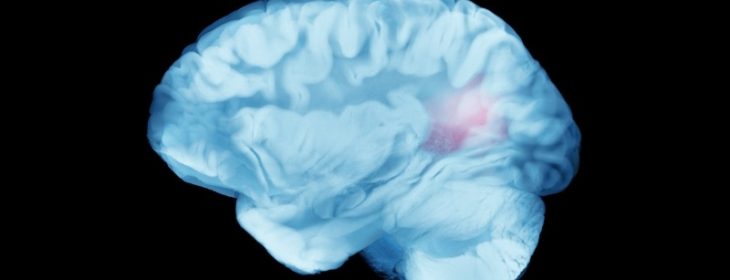 AllergoOncology: Lessons Learned from the Allergy-Glioblastoma Connection