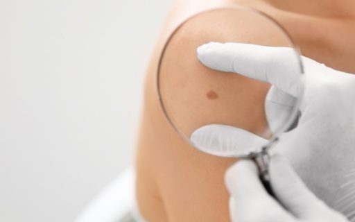 Cytotoxic NK Cells Impede Response to Checkpoint Immunotherapy in Melanoma with an Immune-Excluded Phenotype