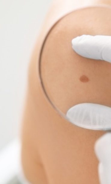 Cytotoxic NK Cells Impede Response to Checkpoint Immunotherapy in Melanoma with an Immune-Excluded Phenotype