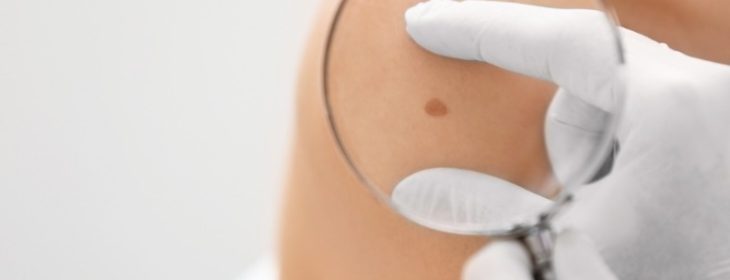 Cytotoxic NK Cells Impede Response to Checkpoint Immunotherapy in Melanoma with an Immune-Excluded Phenotype