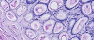 The Role of ILC2 in Tissue Homeostasis and Neoplasia