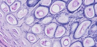 The Role of ILC2 in Tissue Homeostasis and Neoplasia